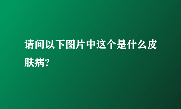 请问以下图片中这个是什么皮肤病?