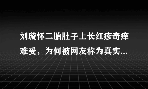 刘璇怀二胎肚子上长红疹奇痒难受，为何被网友称为真实的孕妈？