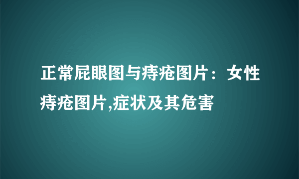 正常屁眼图与痔疮图片：女性痔疮图片,症状及其危害