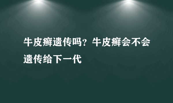 牛皮癣遗传吗？牛皮癣会不会遗传给下一代