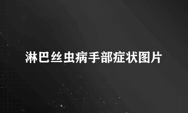 淋巴丝虫病手部症状图片