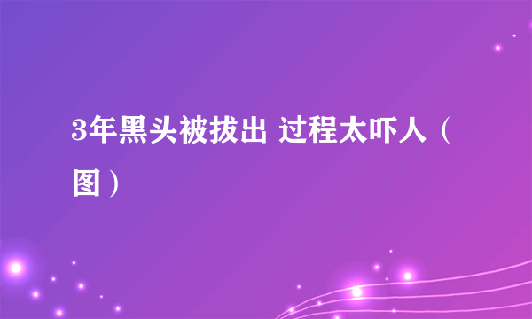 3年黑头被拔出 过程太吓人（图）