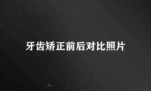 牙齿矫正前后对比照片