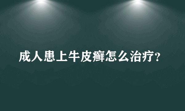 成人患上牛皮癣怎么治疗？