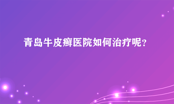 青岛牛皮癣医院如何治疗呢？