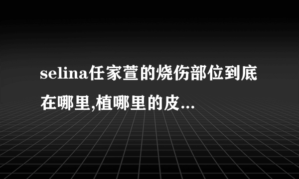 selina任家萱的烧伤部位到底在哪里,植哪里的皮为什么要剪头发？