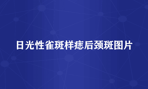 日光性雀斑样痣后颈斑图片